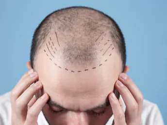 Hair Transplant